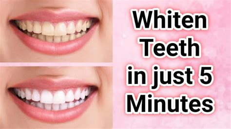 Get the smile of your dreams: the power of magic white teeth whitening